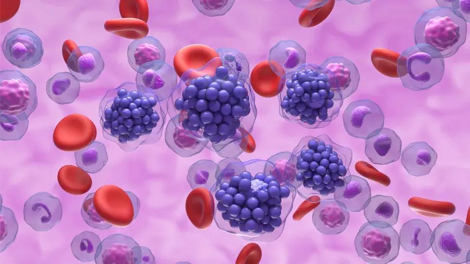 large B-cell lymphoma | Image credit: Cleveland Clinic