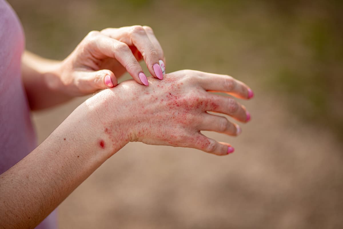 Lebrikizumab improved quality of life and mental health in patients with atopic dermatitis in a pair of studies. | Image Credit: InfiniteStudio - stock.adobe.com