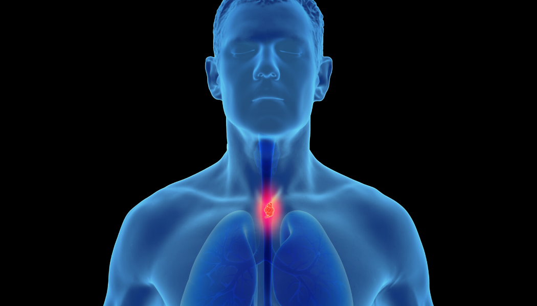 Esophageal cancer