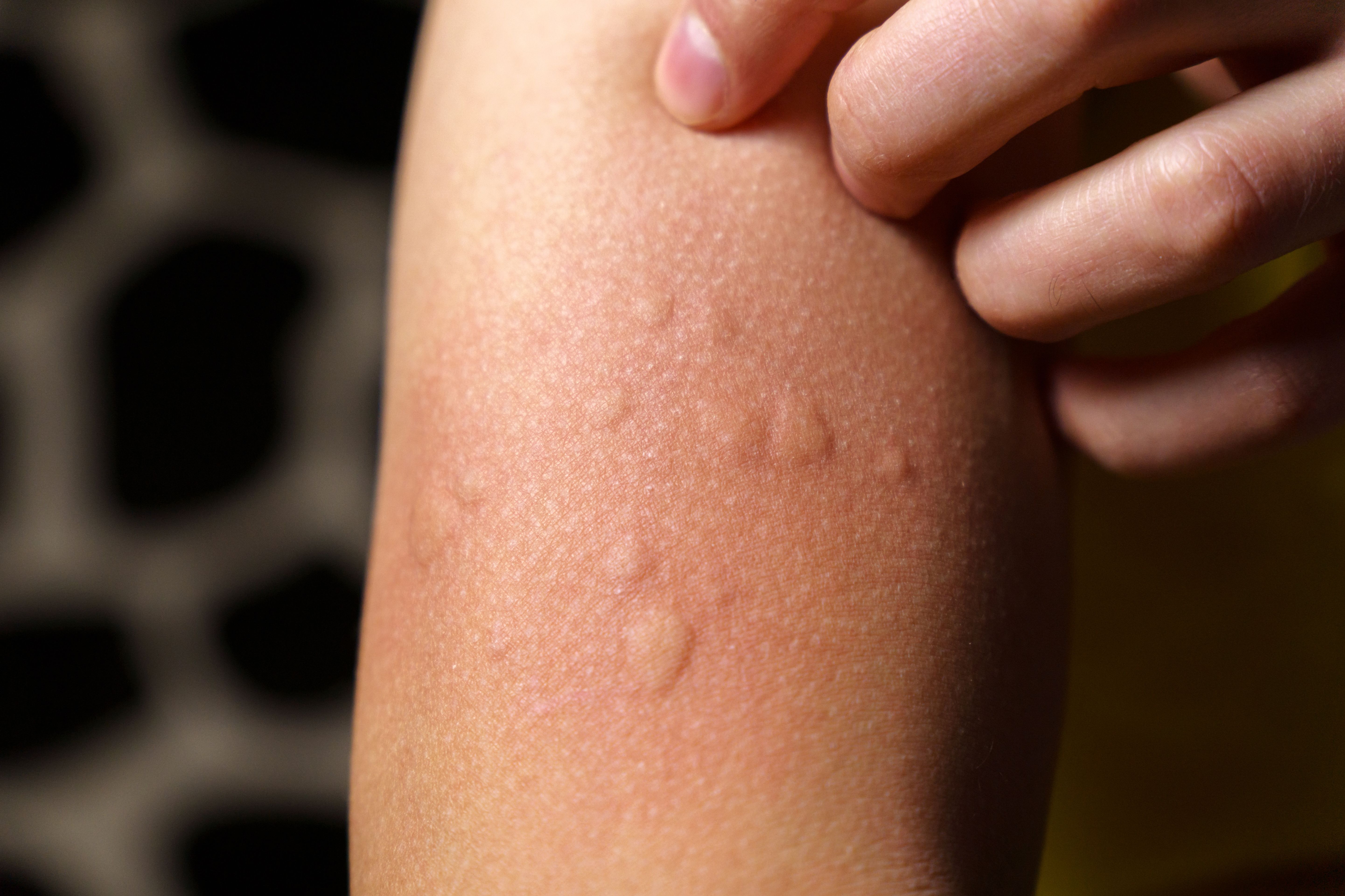 Skin hives. | Image Credit: Алексей Филатов - stock.adobe.com 