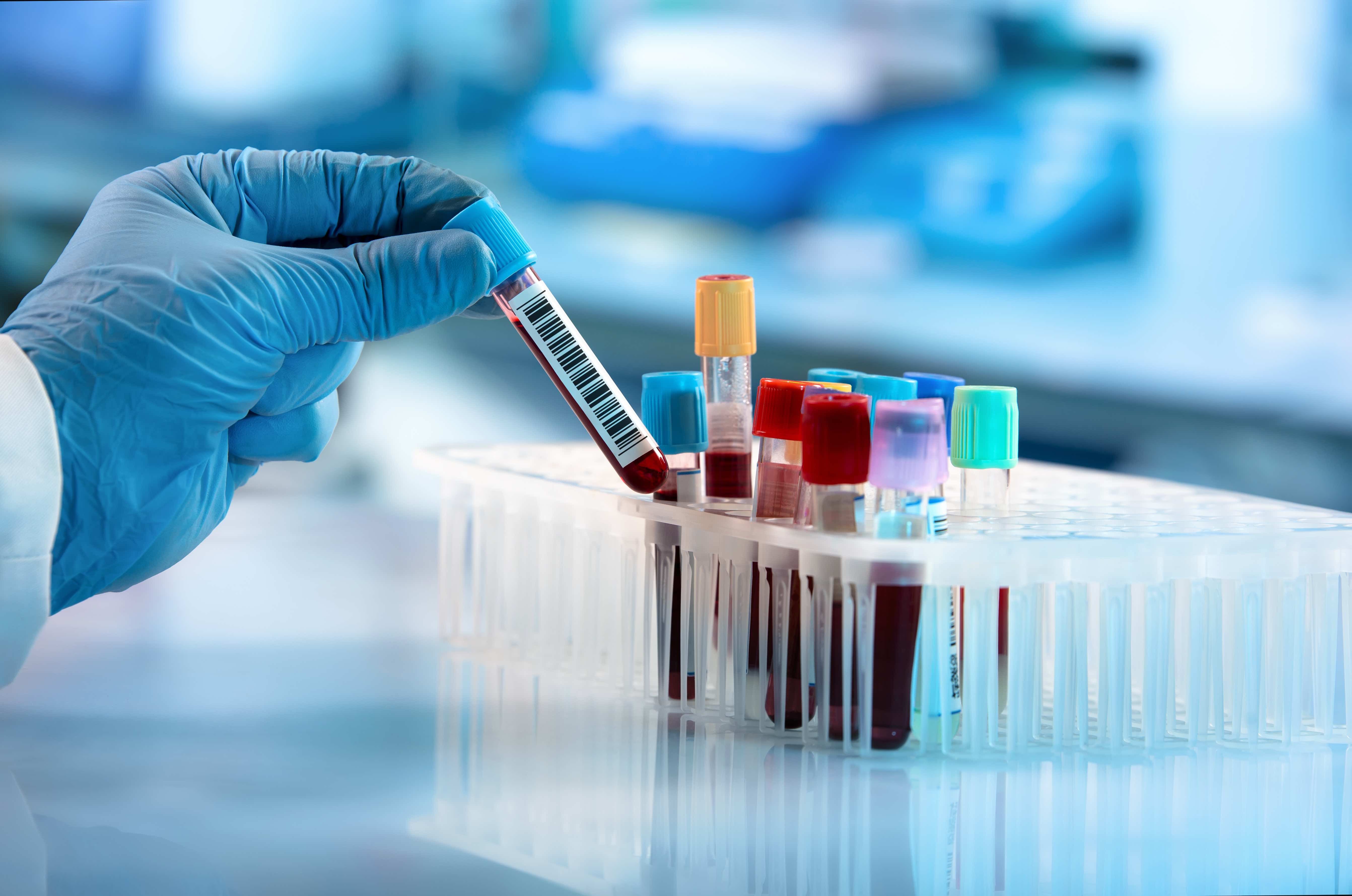Blood testing - angellodeco - stok.adobe.com.jpg