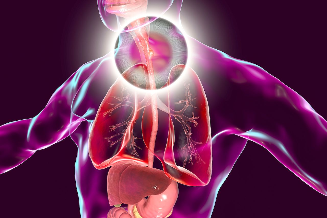 Esophageal cancer illustration | Image credit: Dr_Microbe - stockadobe.com