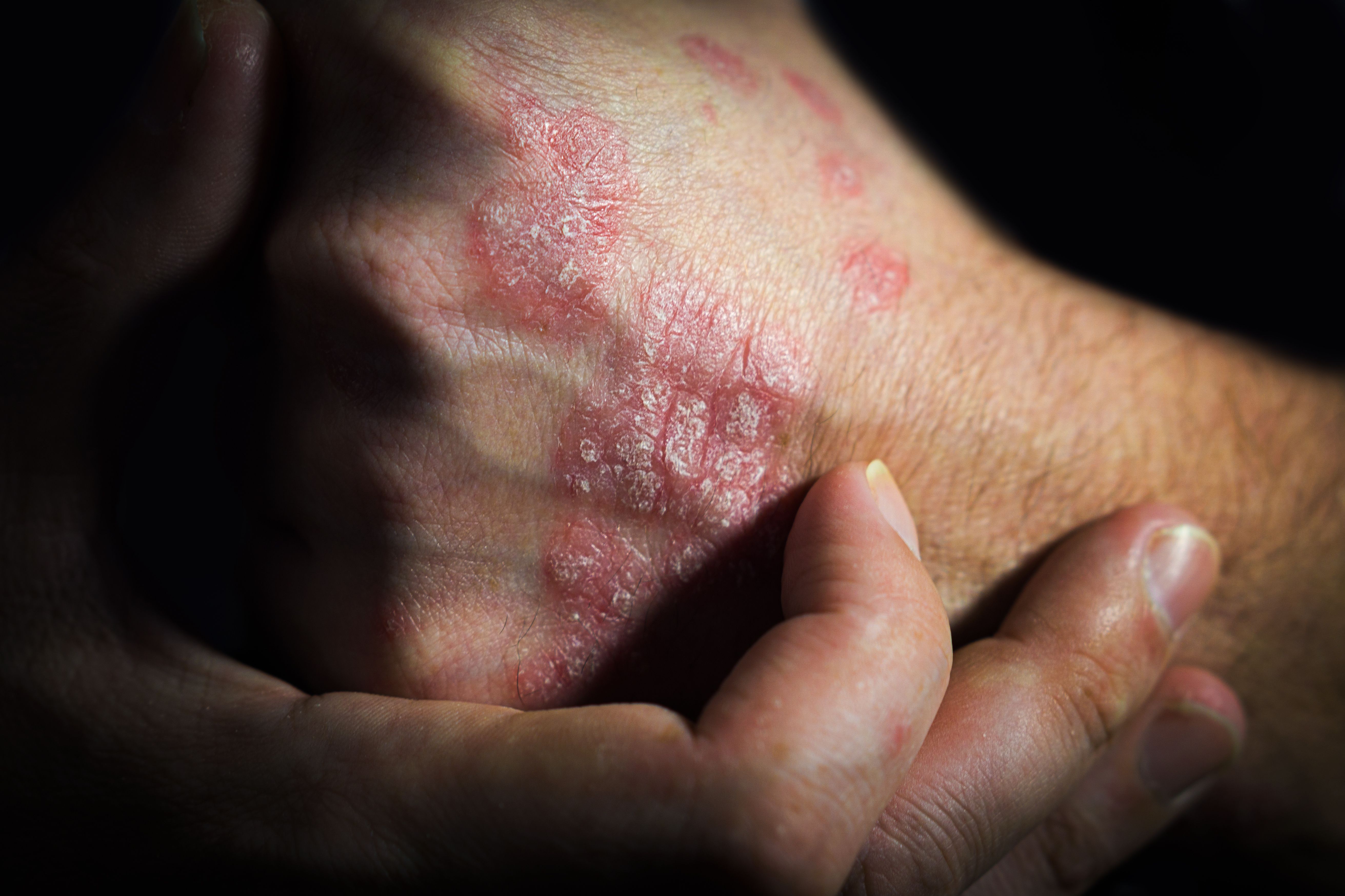 Mindera Health and Liviniti Partner to Improve the Management of Psoriasis With Precision Medicine 