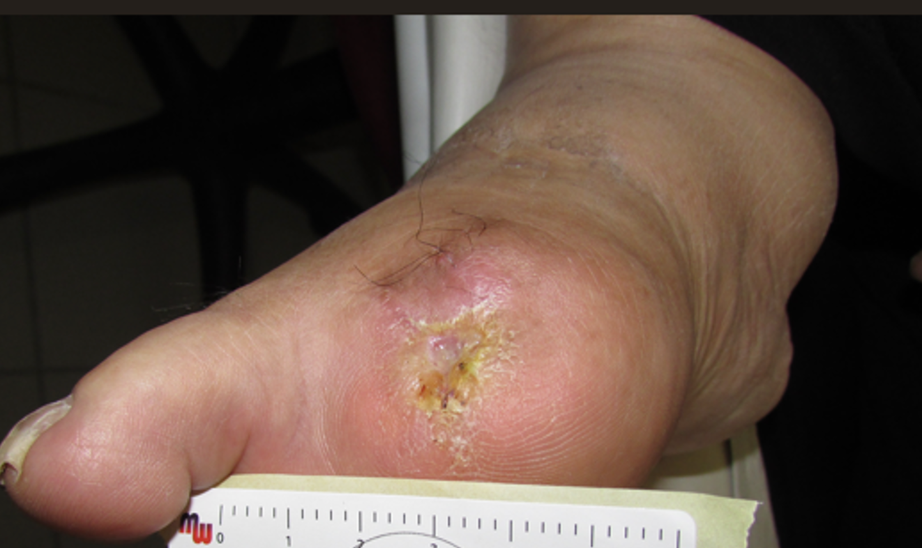 Closing the Wound Care Gap: Addressing Disparities in Amputations and Limb Preservation 