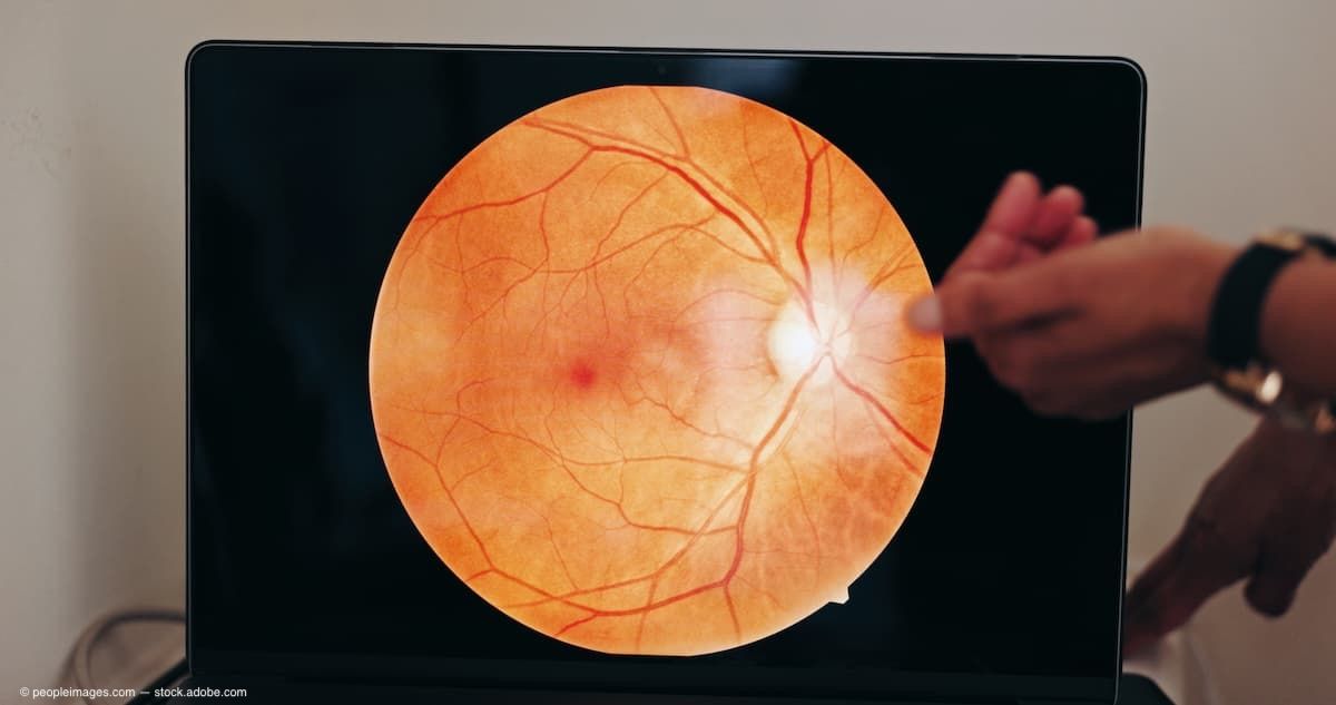 Retinal imaging study suggests new biomarkers for early diabetic retinopathy detection