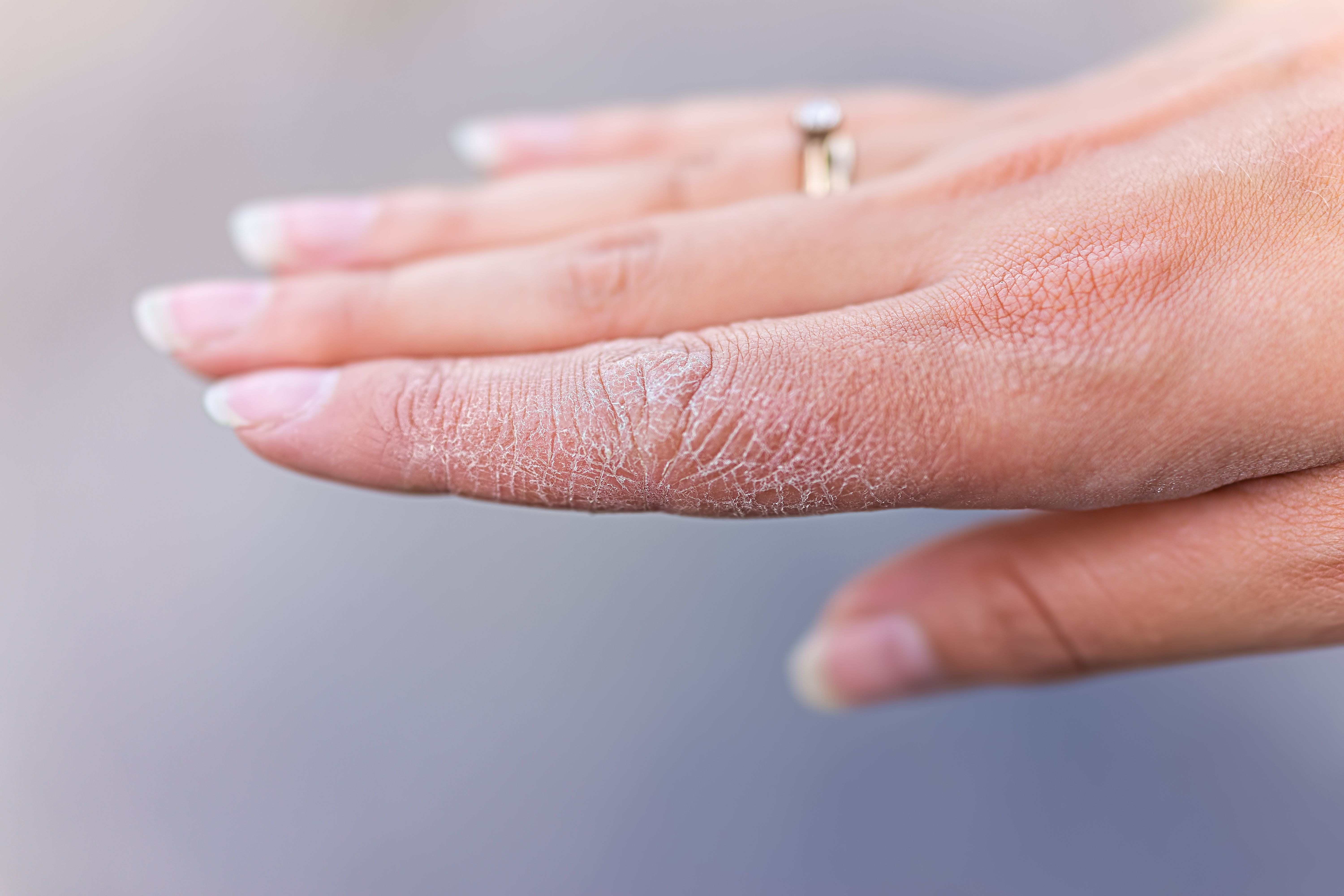 Dry, cracked skin on finger | Image Credit: © Andriy Blokhin - stock.adobe.com