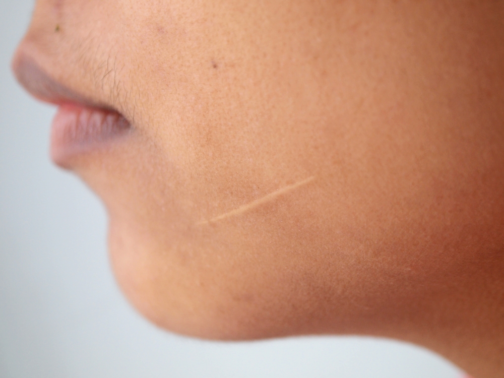 Image New Jersey Workers' Compensation for Facial Disfigurement